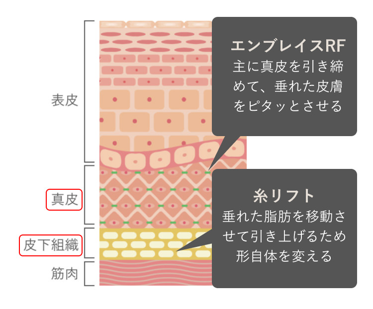 糸リフトとエンブレイスRF効果はどう違うの？ エンブレイスRF 主に真皮を引き締めて、垂れた皮膚をピタッとさせる 糸リフト 垂れた脂肪を移動させて引き上げるため形自体を変える 表皮 真皮 皮下組織 筋肉