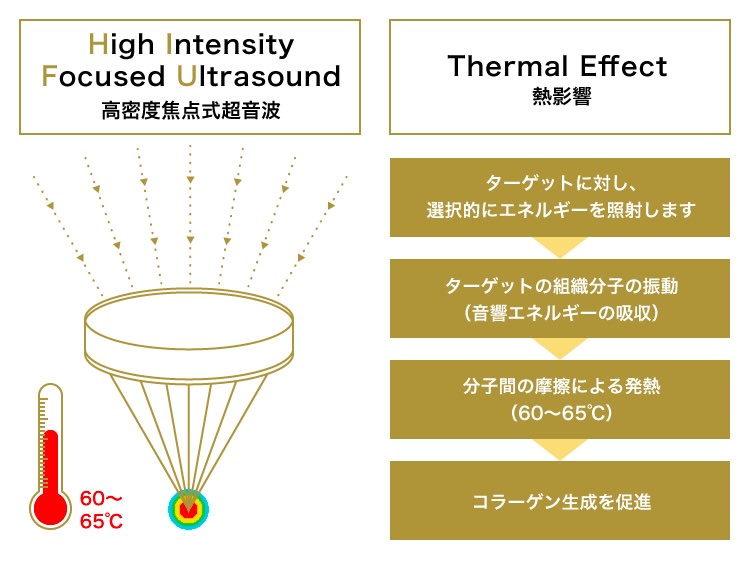 High Intensity Focused Ultrasound 高密度焦点式超音波 Thermal Effect 熱影響 ターゲットに対し、選択的にエネルギーを照射します ターゲットの組織分子の振動（音響エネルギーの吸収） 分子間の摩擦による発熱（60〜65℃） コラーゲン生成を促進