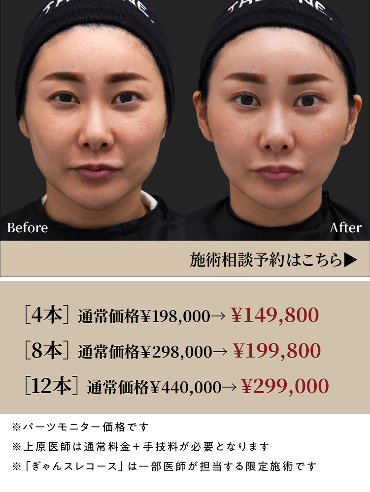 おまかせ糸リフト