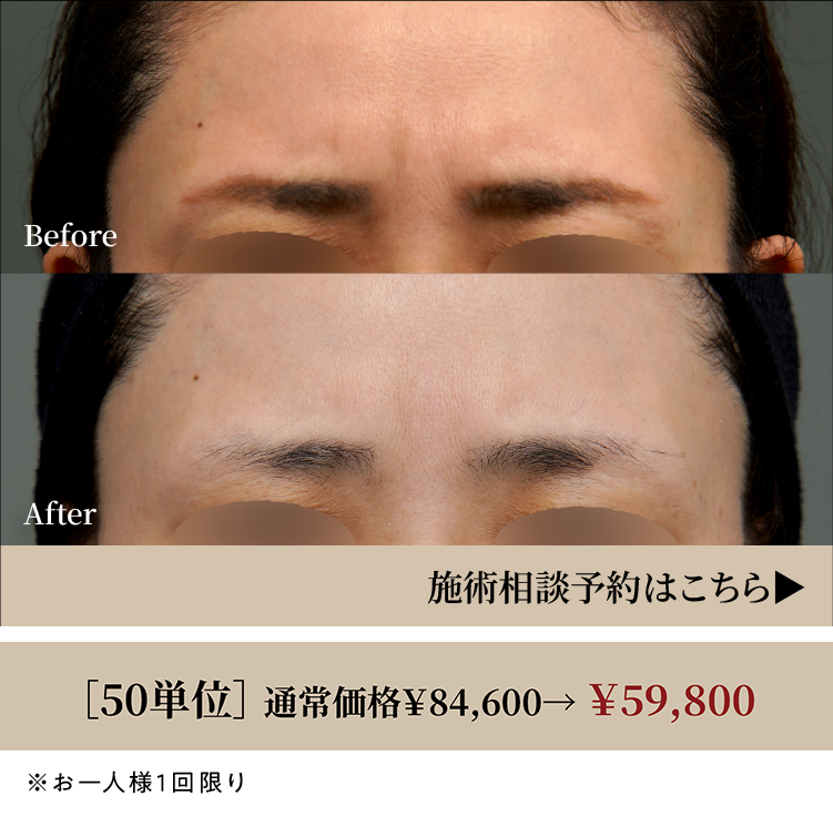 おまかせボトックス
