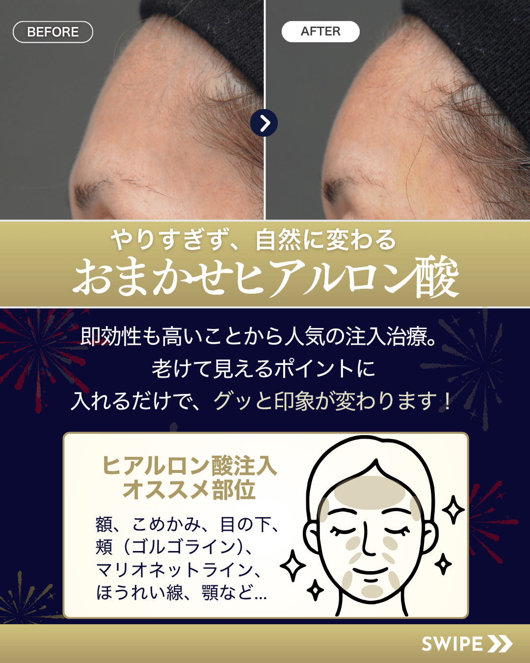 おまかせヒアルロン酸
