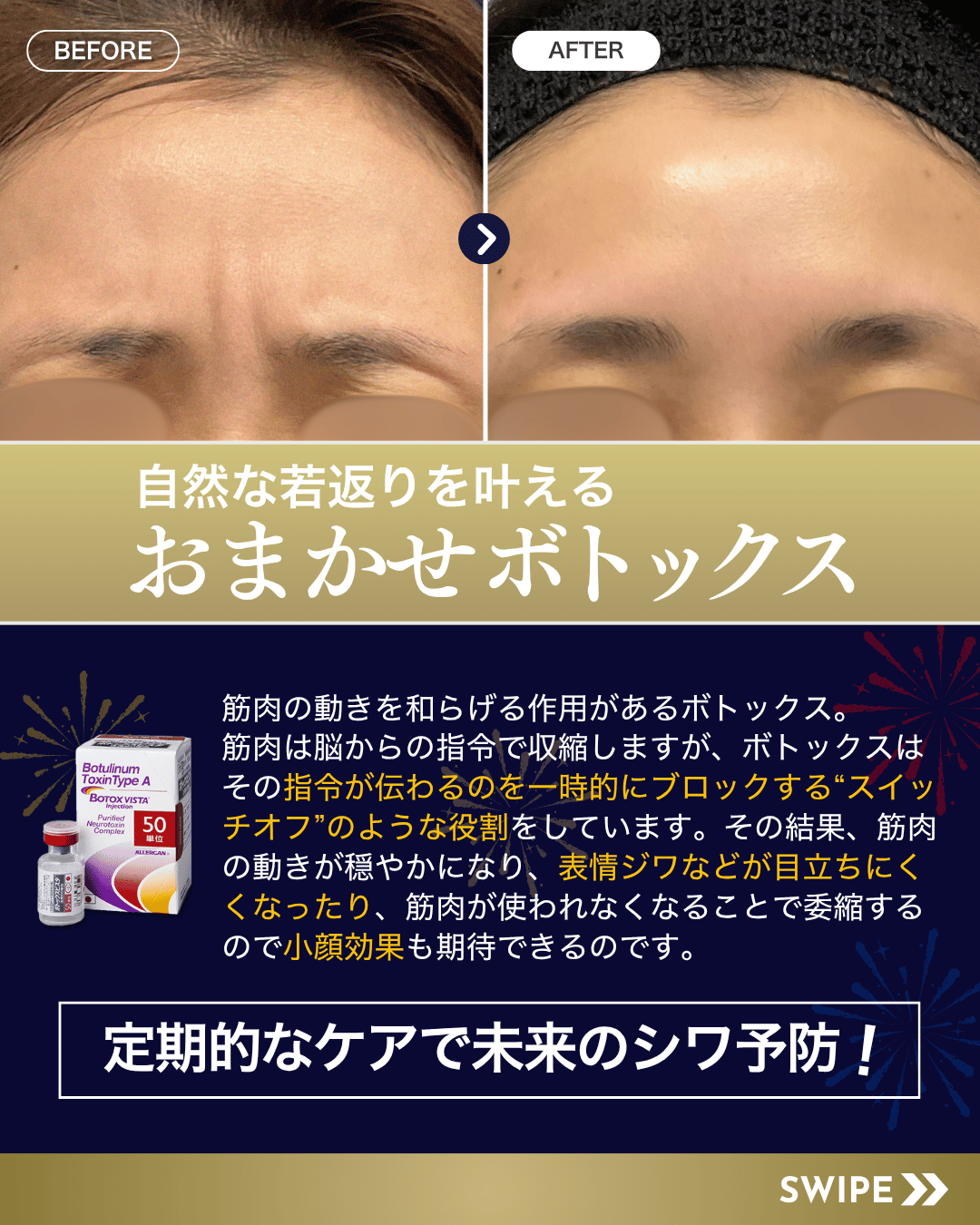 おまかせボトックス