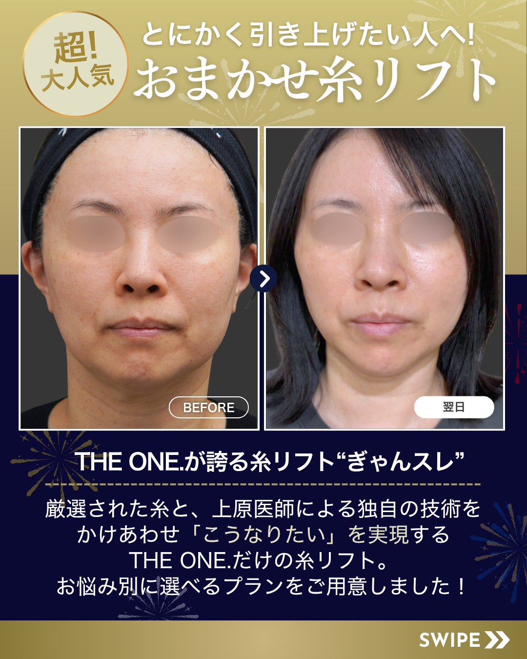 おまかせ糸リフト