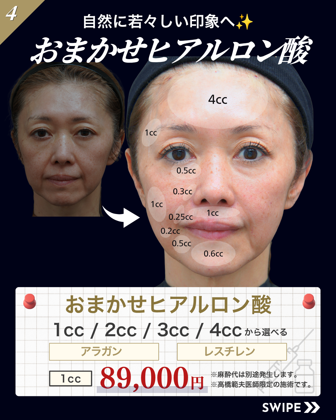 【高橋医師限定】ヒアルロン酸