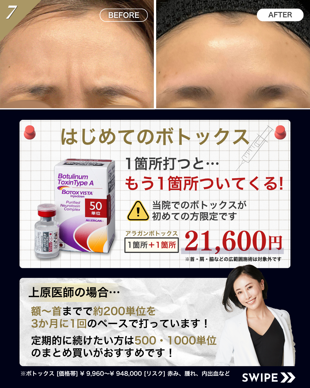 はじめてのボトックス